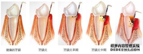 武汉爱齿尔口腔牙周炎治疗